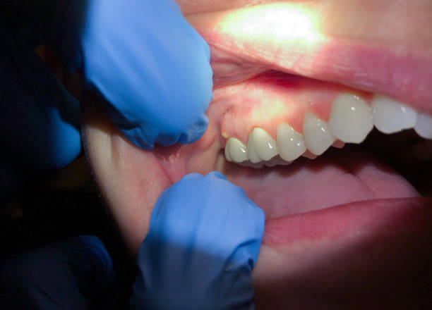 Best Emergency Treatment for Dental Infections or Abscesses in Shady Point, OK